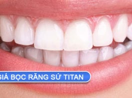 giá bọc răng sứ titan